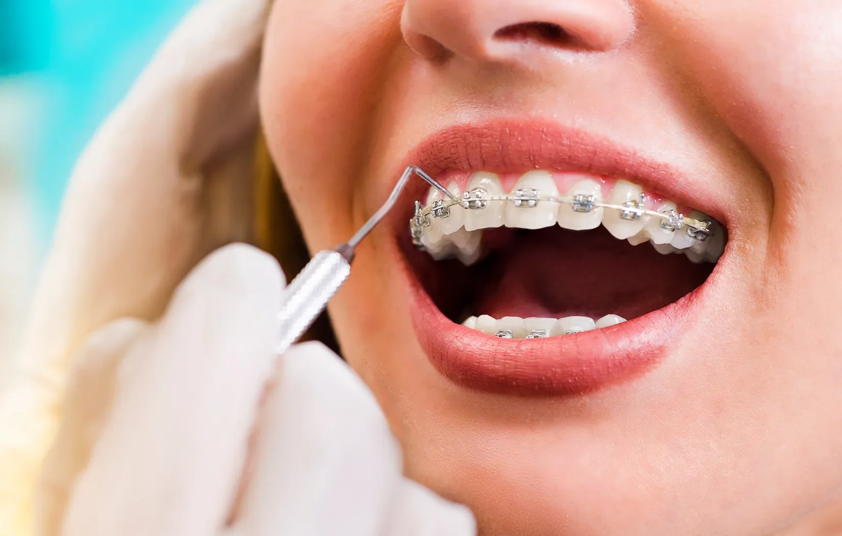 Patient with orthodontics in CA