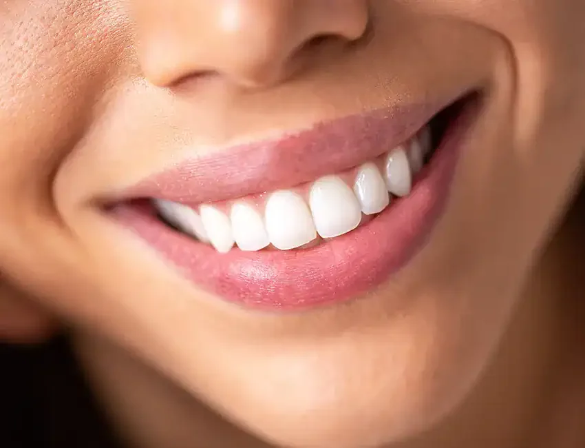 Dental Bonding in Foothill Ranch, CA