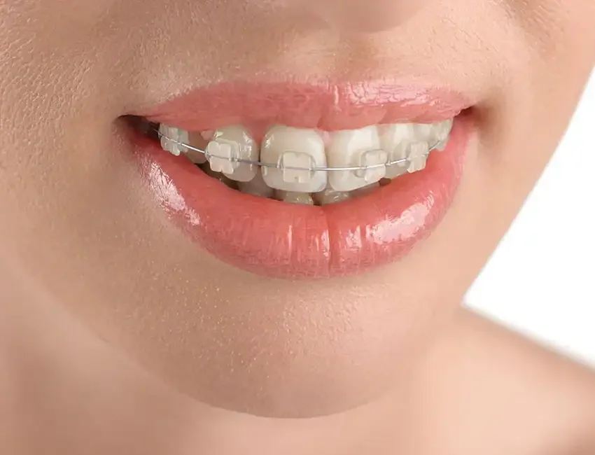 Braces in Foothill Ranch, CA