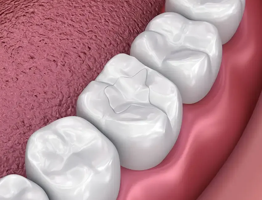 What is Composite Fillings