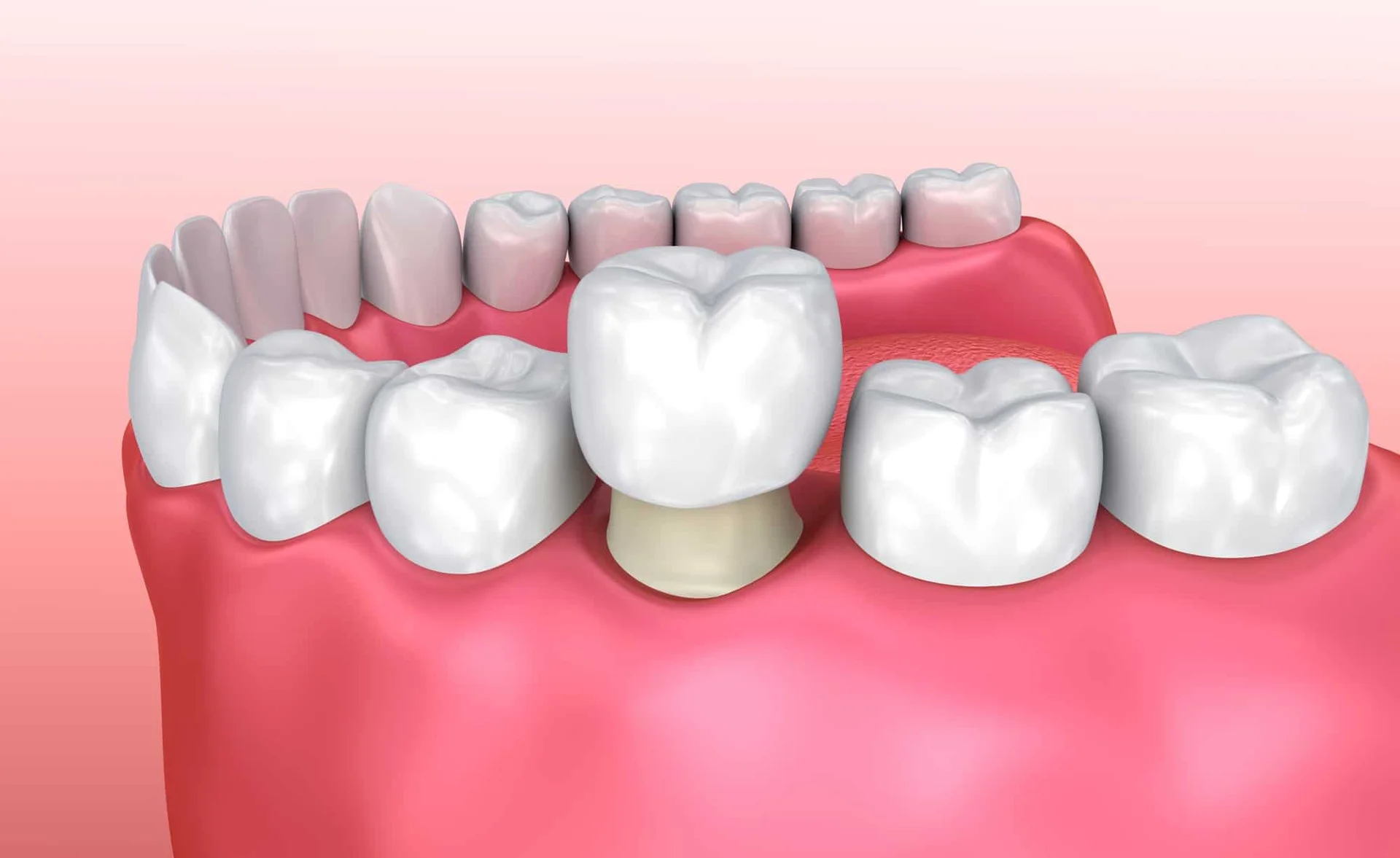 need a dental crown