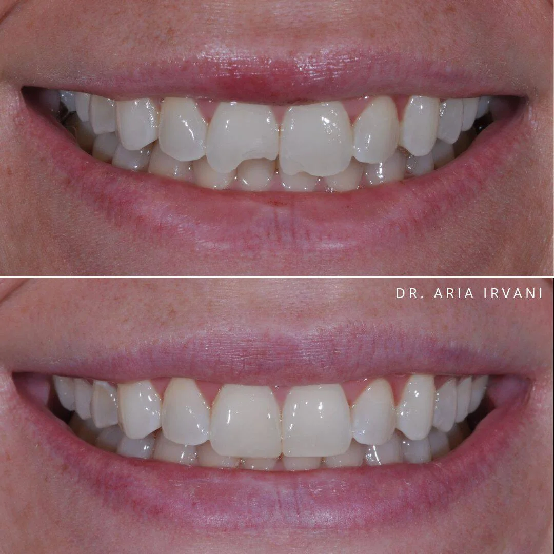 Dental bonding before and after