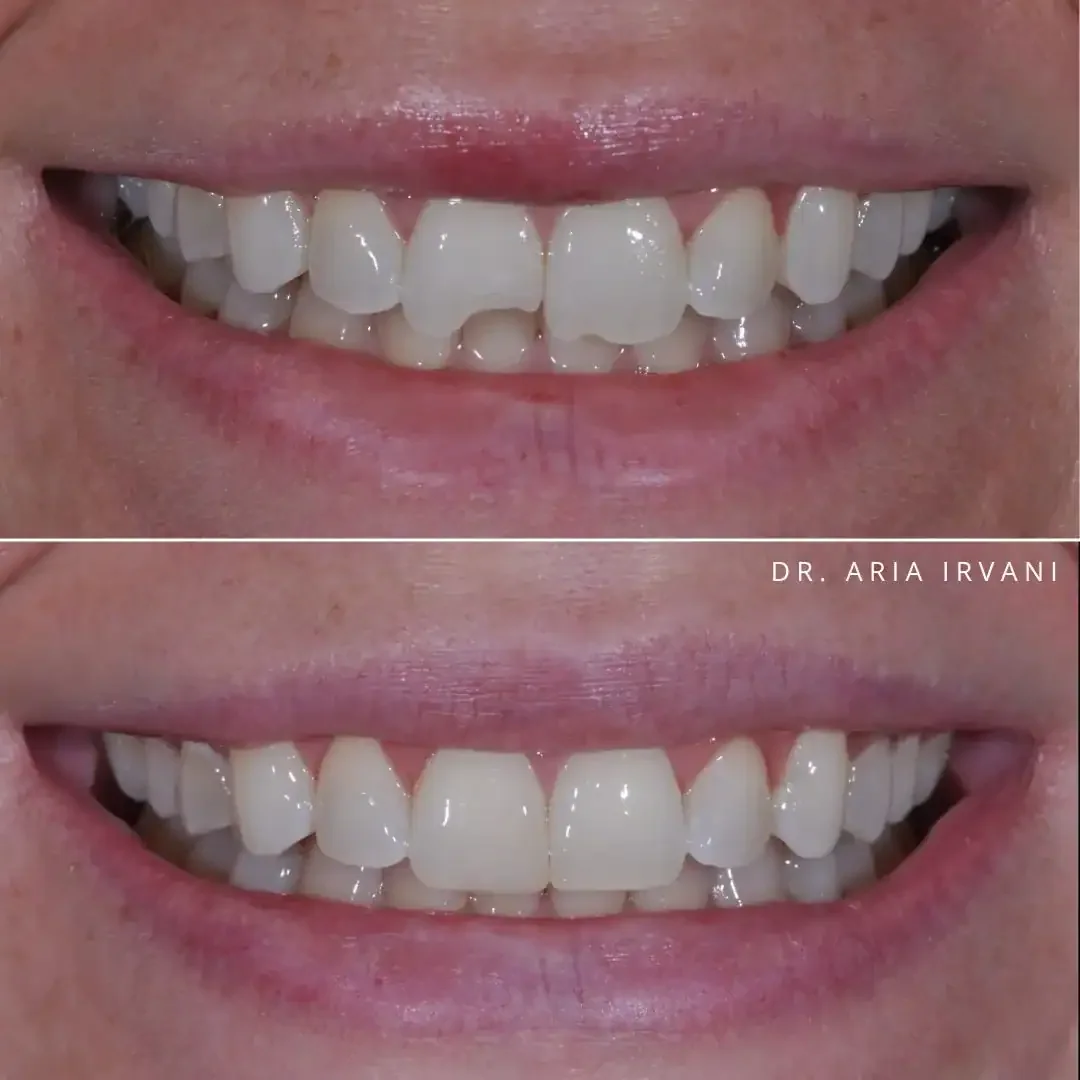 Before and after teeth whitening and alignment at Foothill Ranch Dentistry.