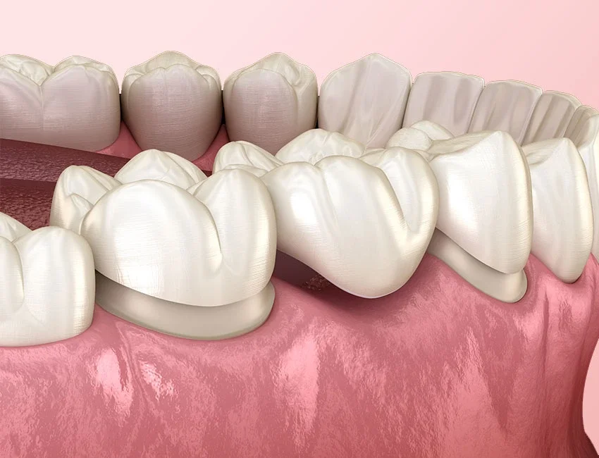 Dental Bridges in Foothill Ranch, CA