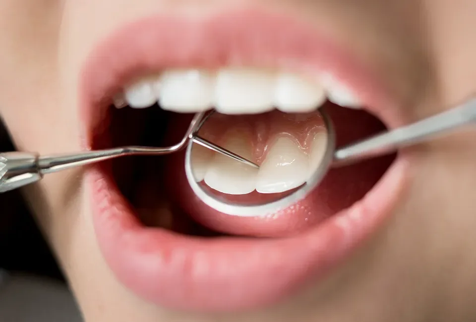 Teeth Cleaning in Foothill Ranch, CA