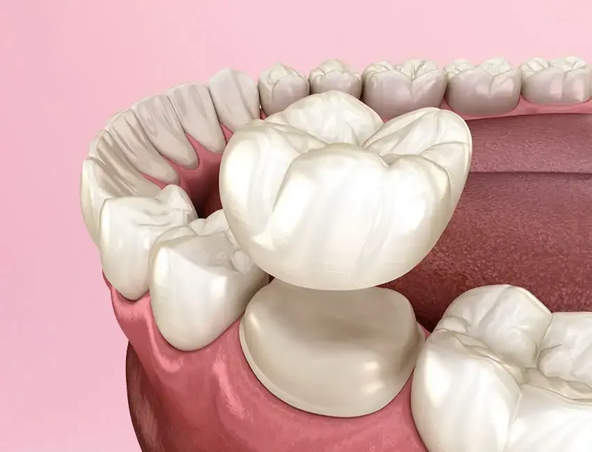 Dental Crowns in Foothill Ranch, CA