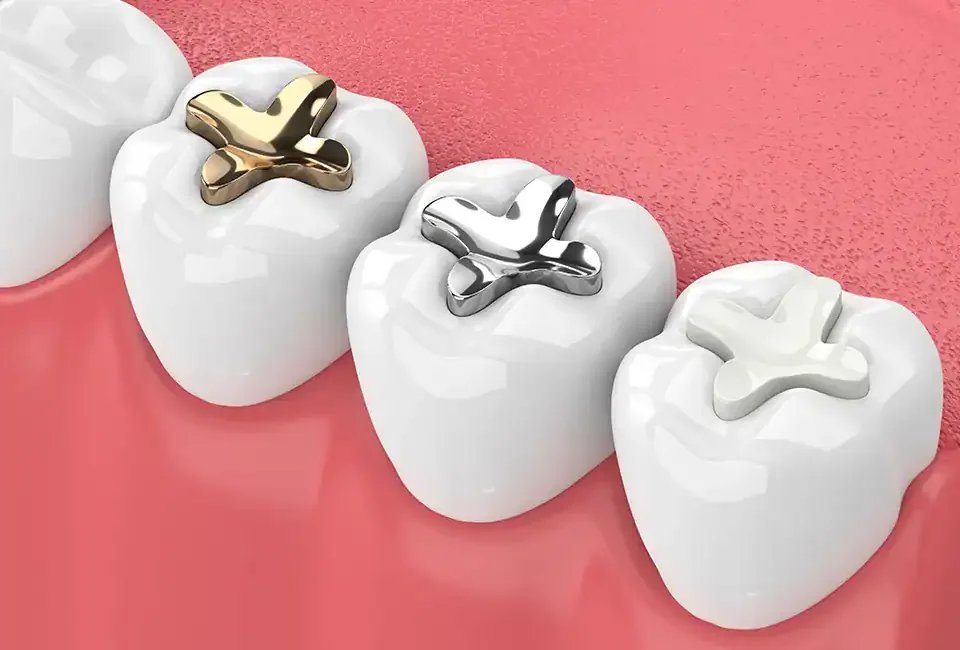 types of dental fillings
