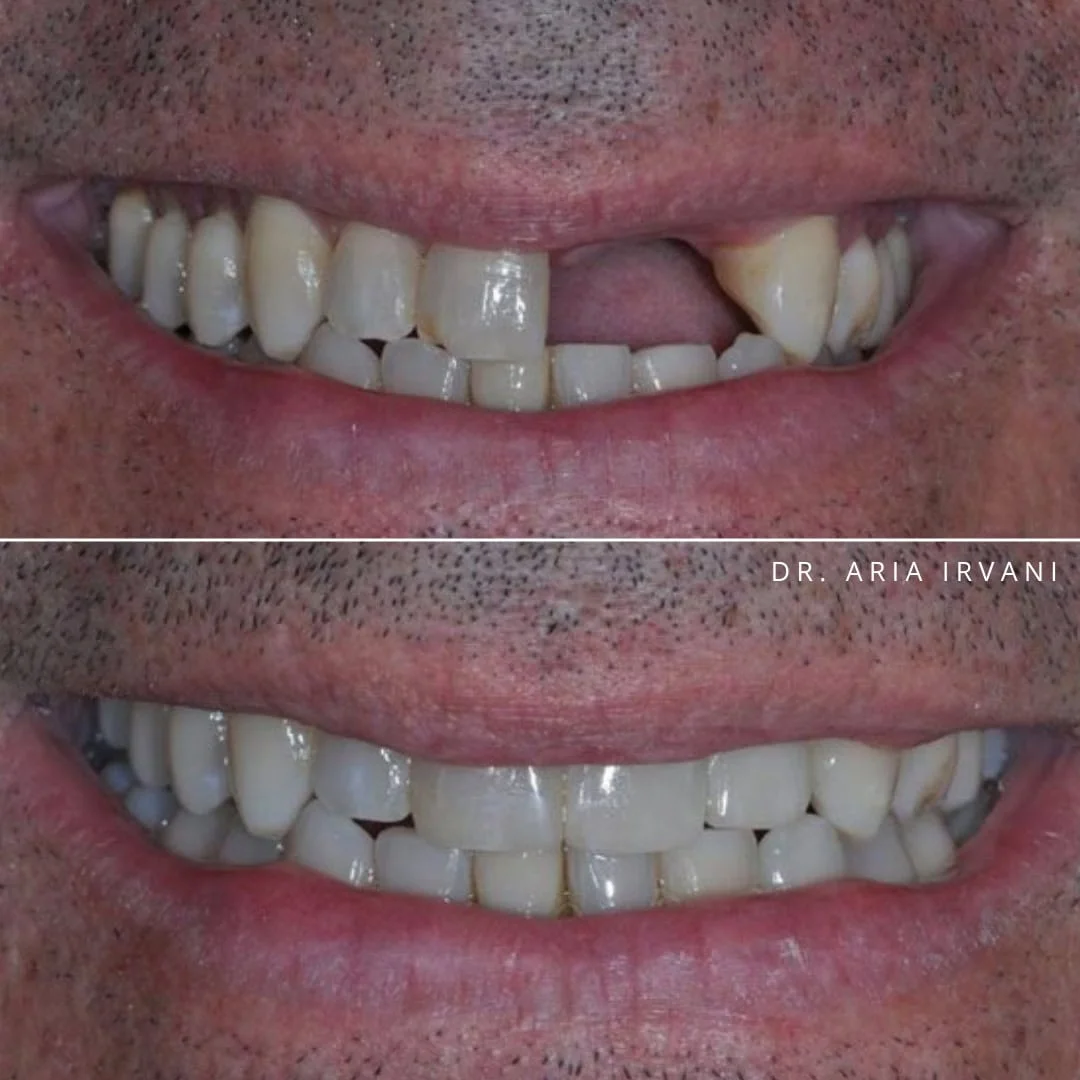 Dental implants before and after
