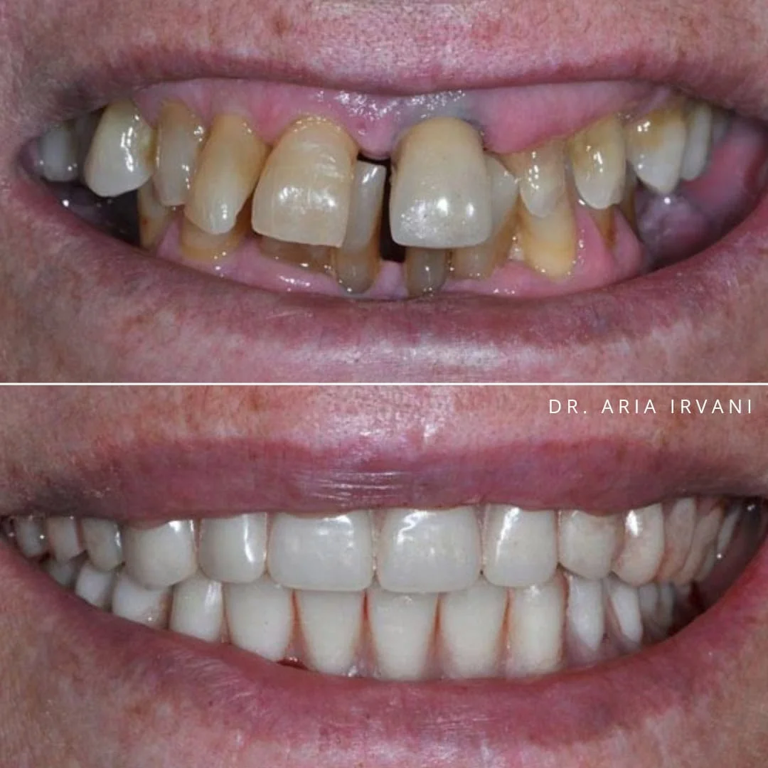 Dental implants before and after