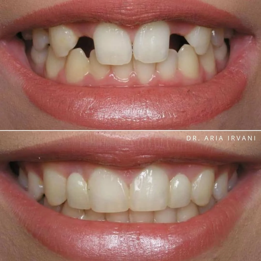 Dental implants before and after
