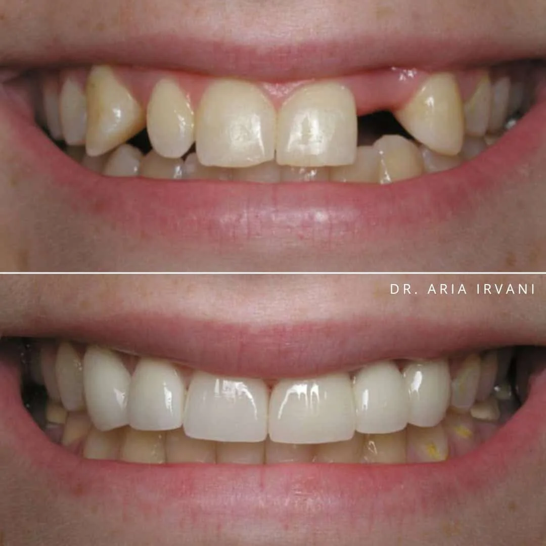 Dental implants before and after