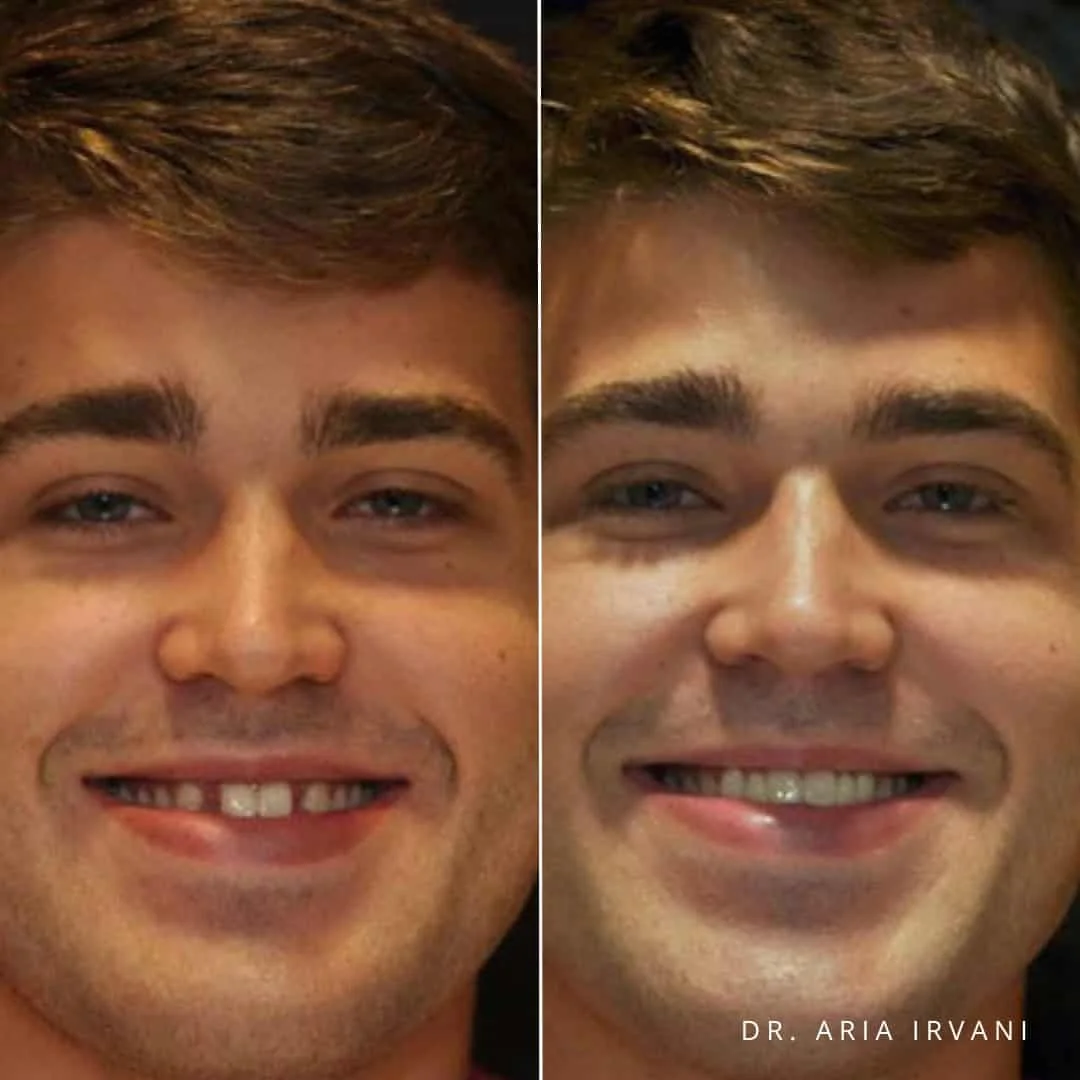 Dental implants before and after