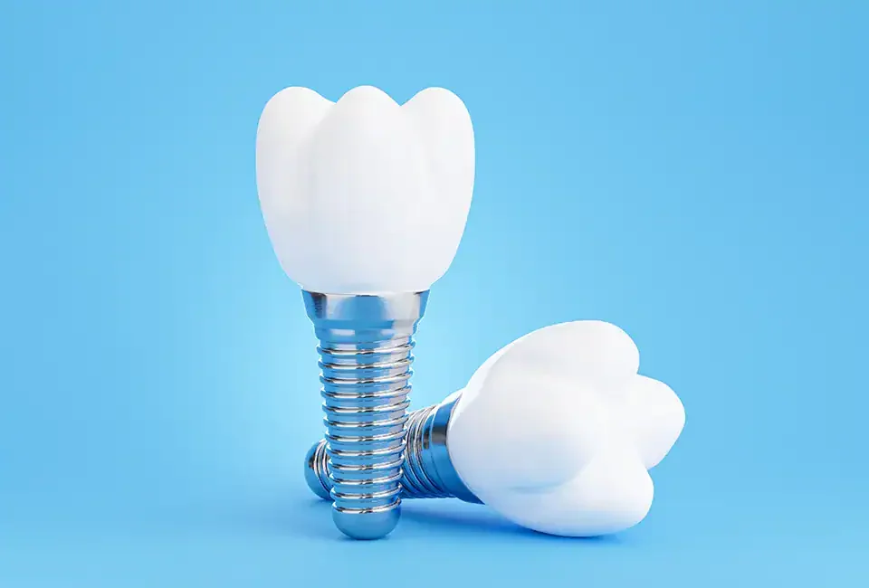 dental implants model