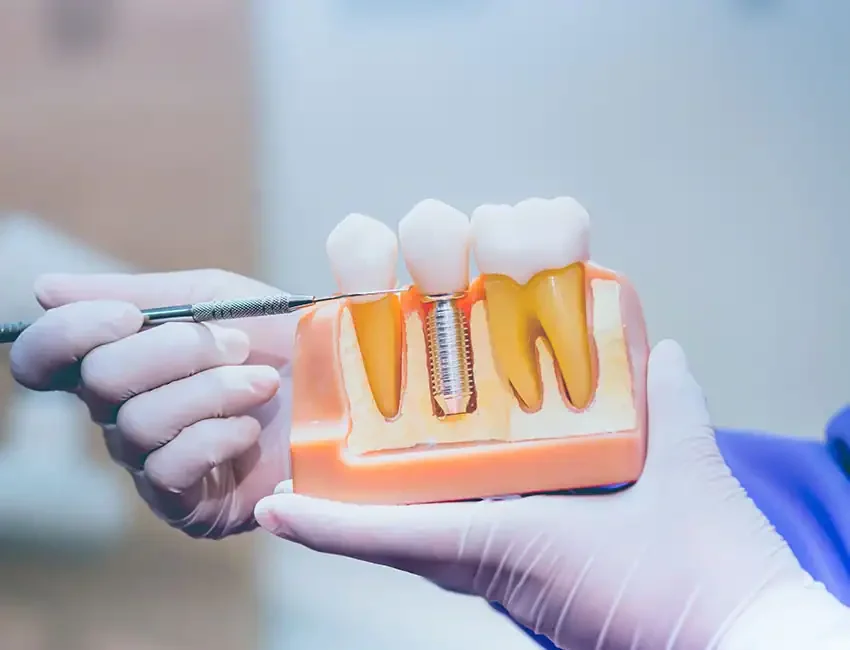 Dental implants in CA