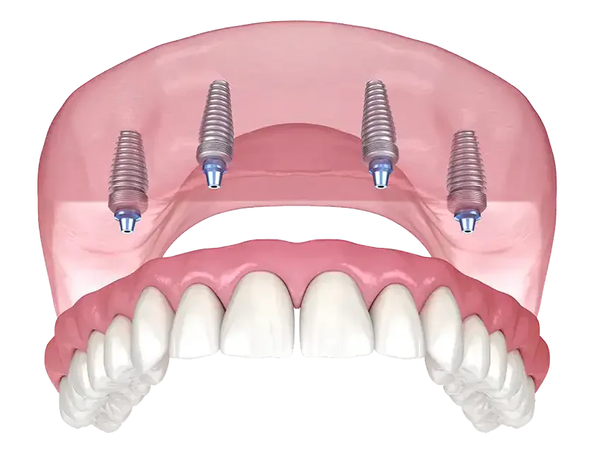 All-on-4 Implants