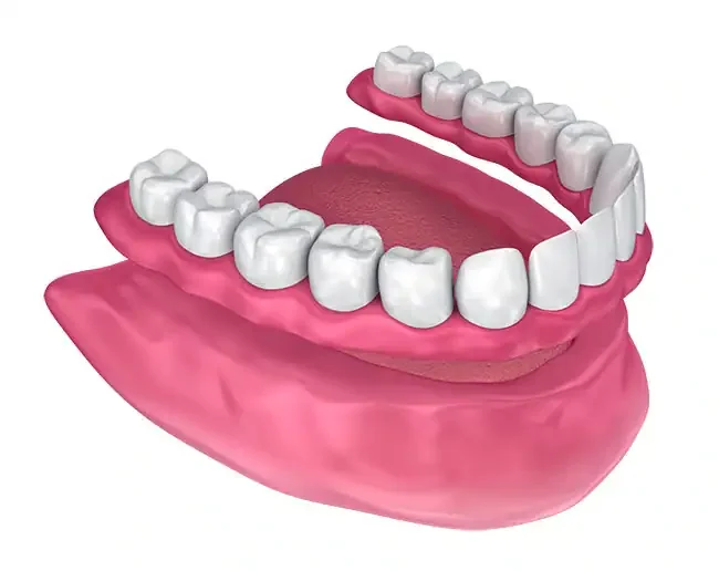 Full Dentures ("Plates")
