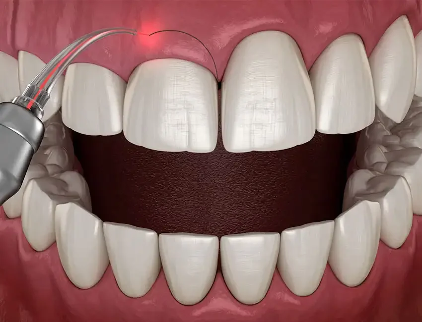 What is Gum Contouring