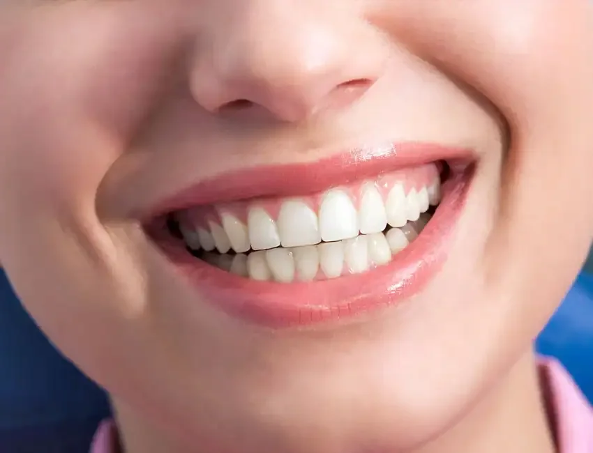What is Dental Bonding