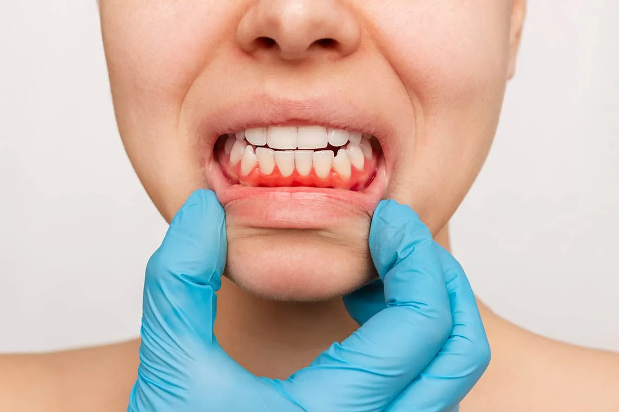 woman with bleeding gums