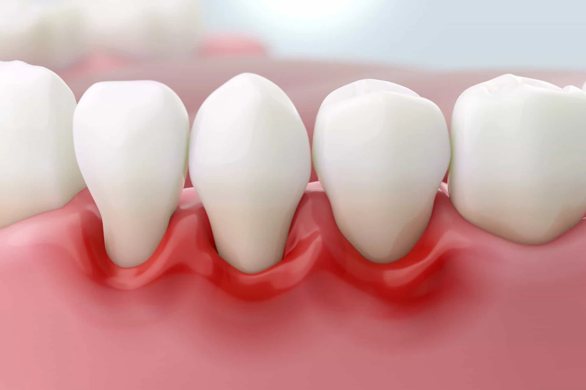 gums bleeding