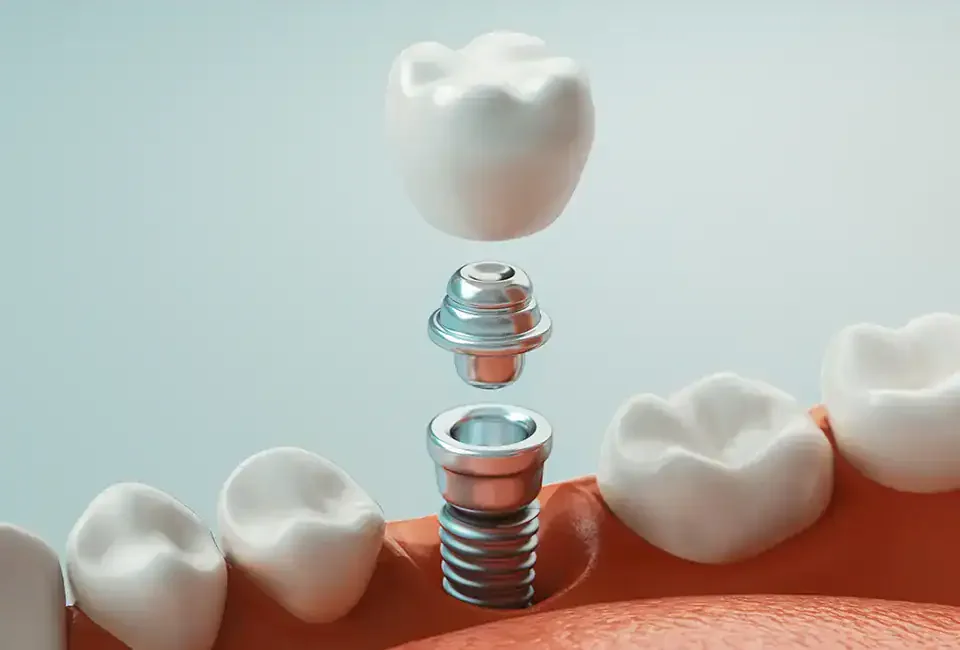 dental implant illustration