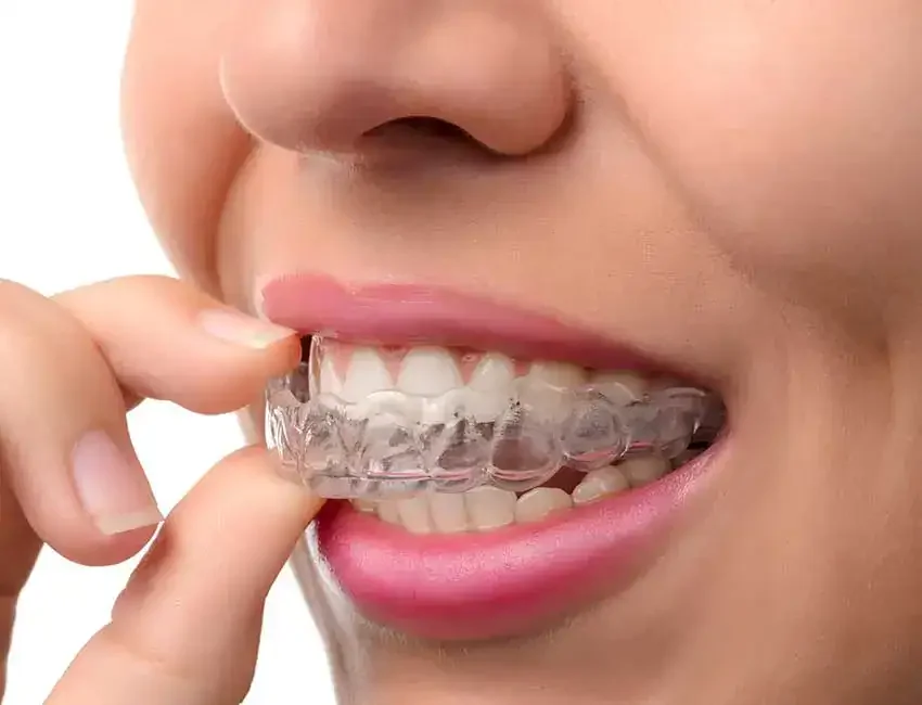 What is Mouth Guards