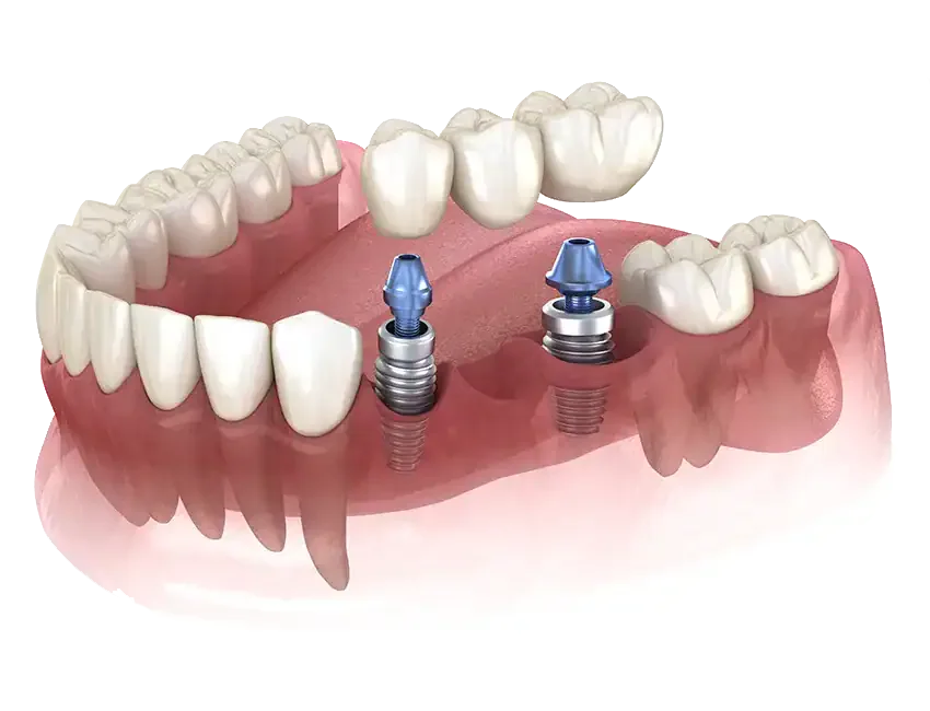 Multi-Tooth Implant Bridges