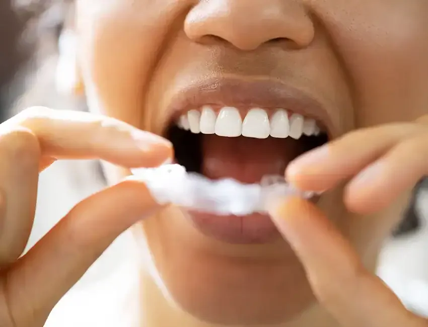 What is TMJ & Bruxism Treatment