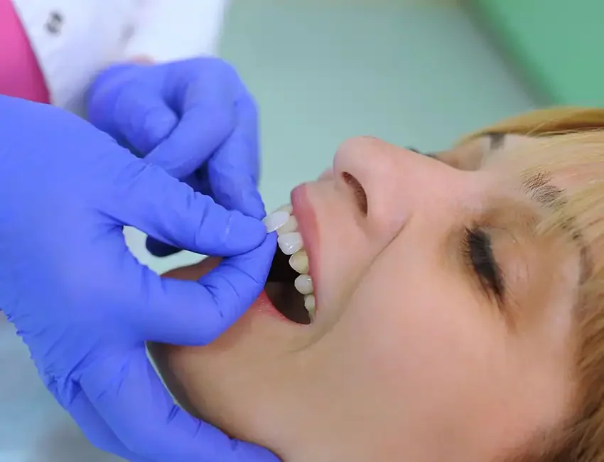 What is Dental Veneers