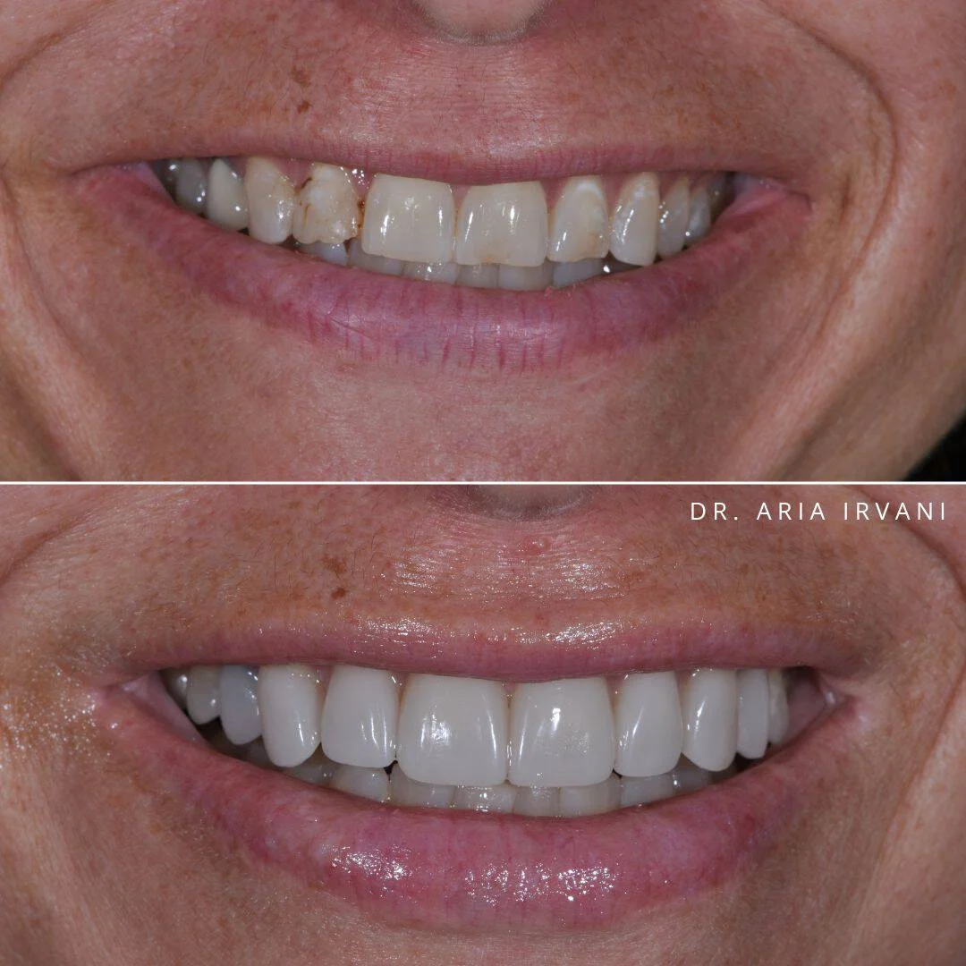 Porcelain veneers before and after