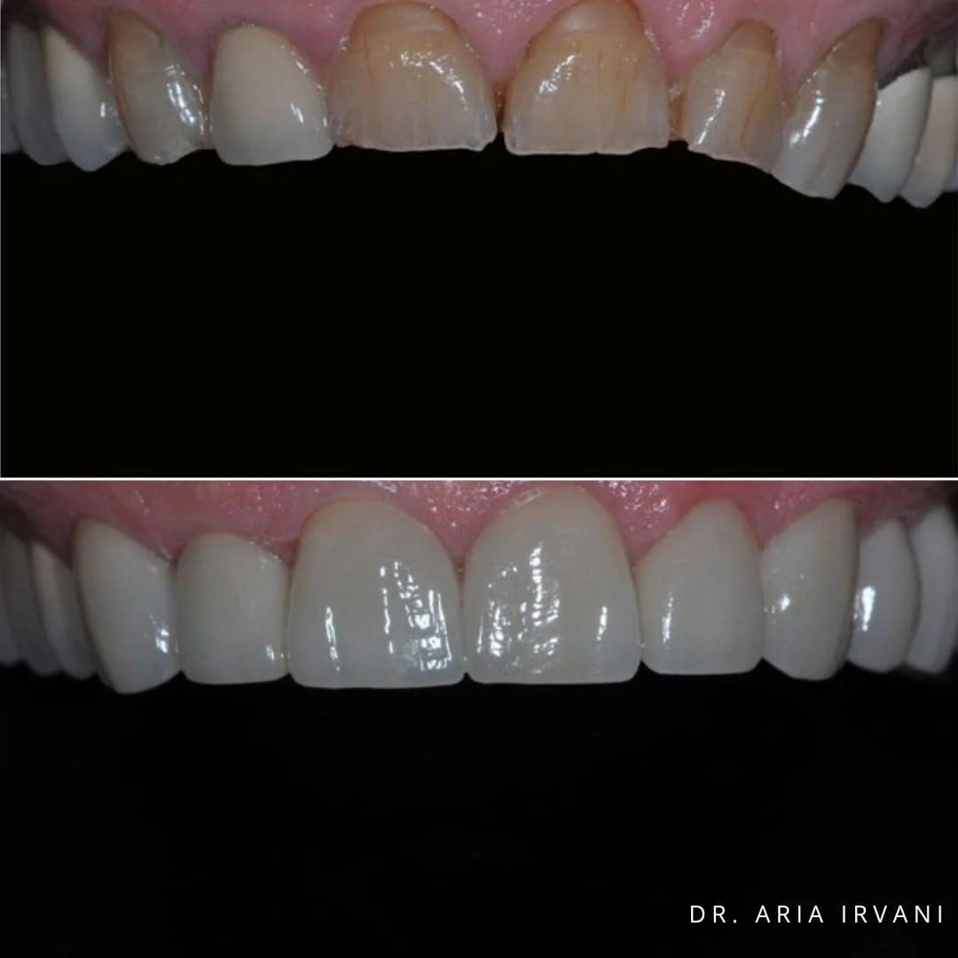 Veneers before and after