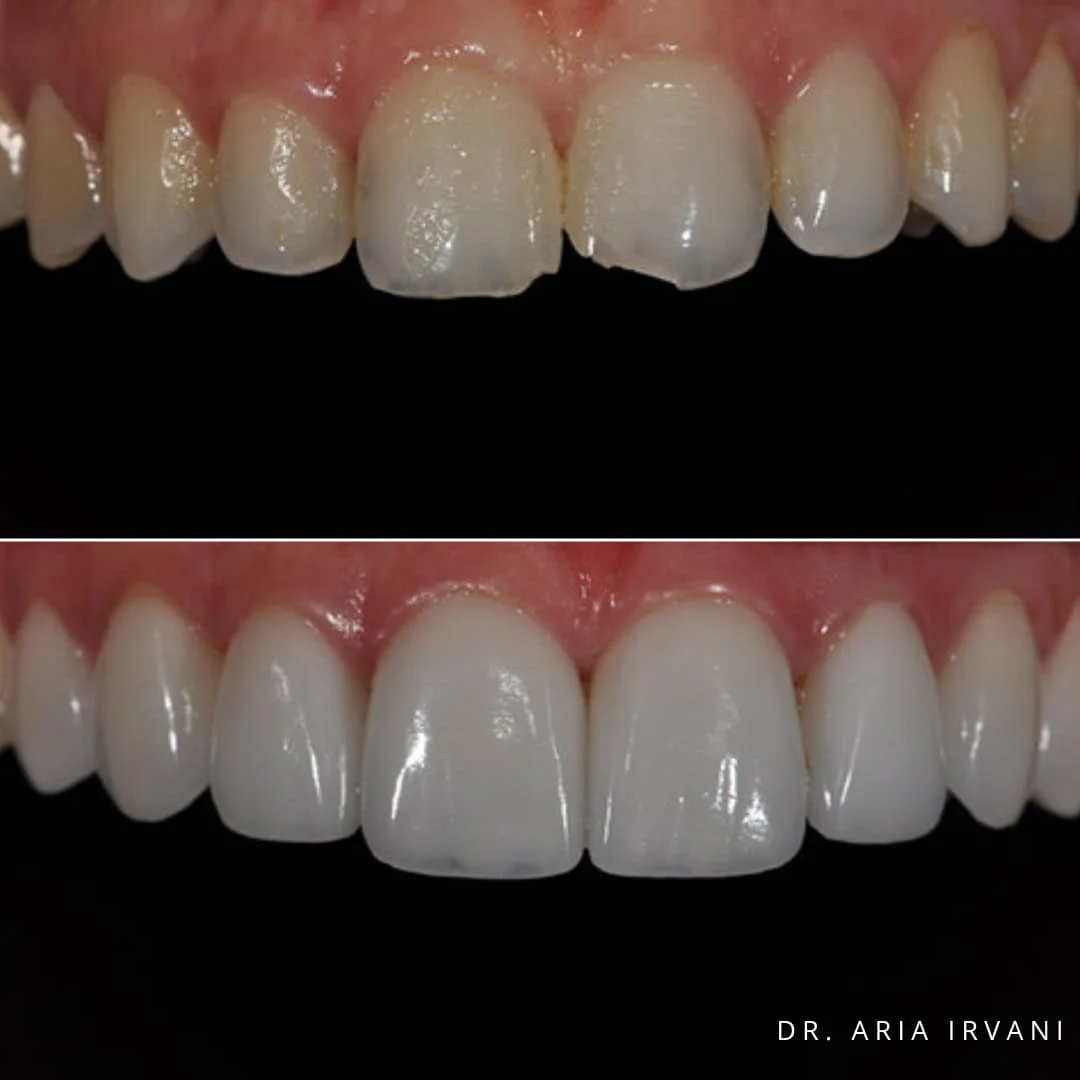 Veneers before and after