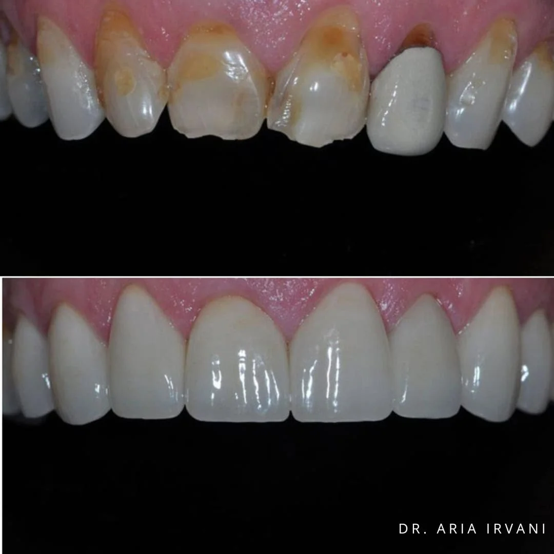 Veneers before and after