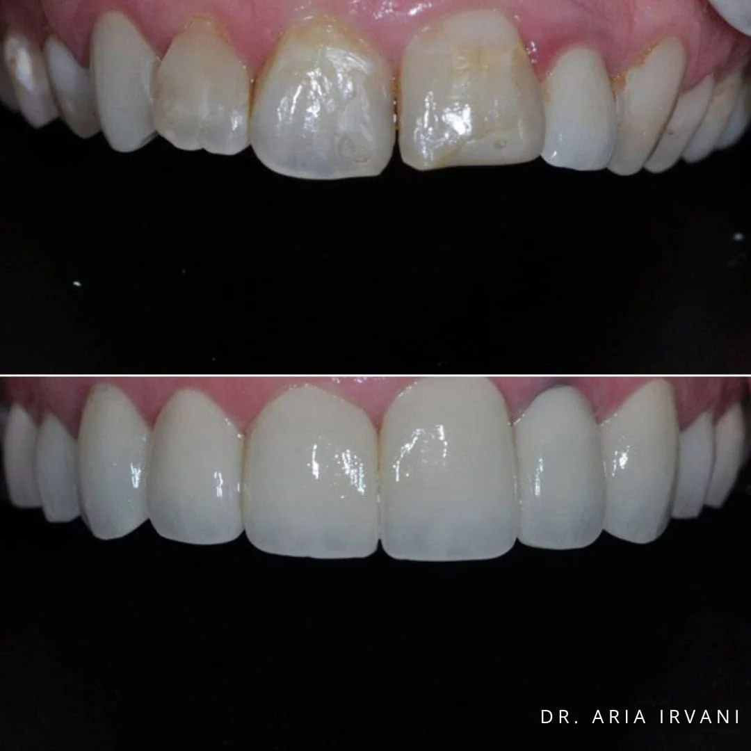 Veneers before and after
