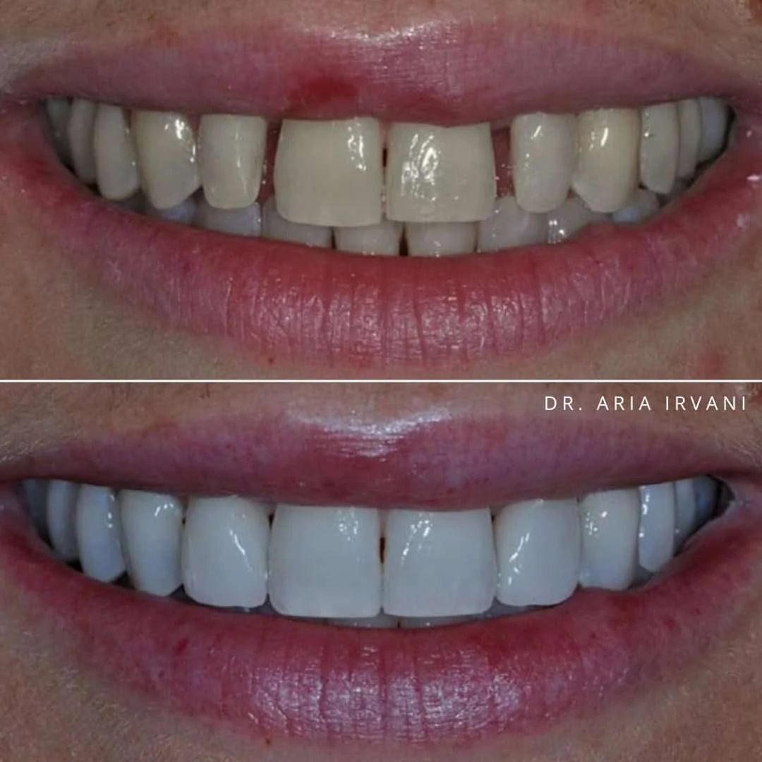 Veneers before and after