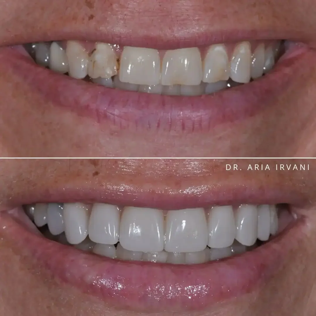 Porcelain veneers smile transformation