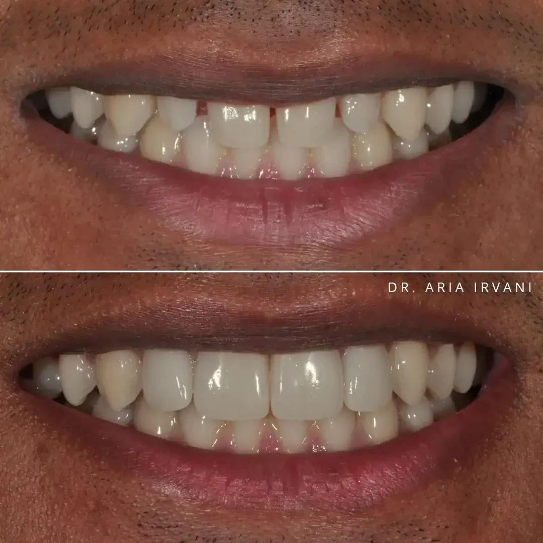 Porcelain veneers smile transformation