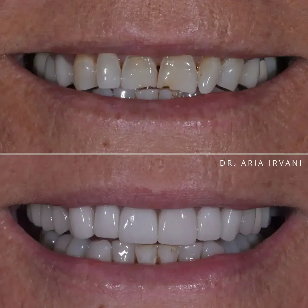 Porcelain veneers smile transformation