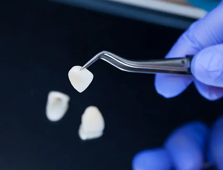 Dental Veneers in Foothill Ranch, CA