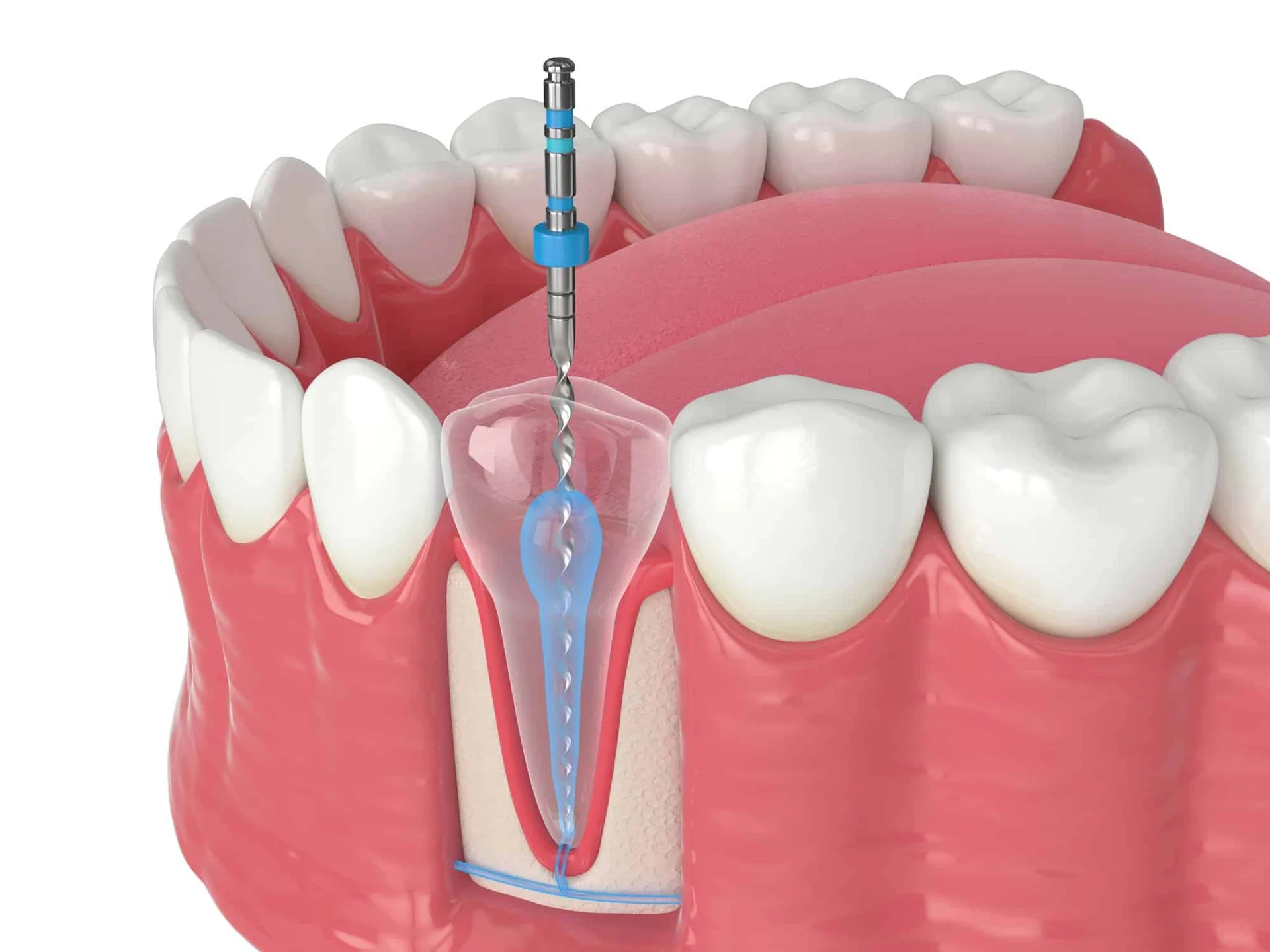 root canal demonstration