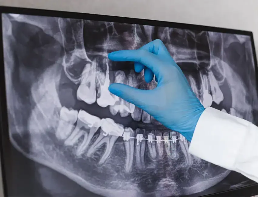 Root Canal Treatment in Foothill Ranch, CA