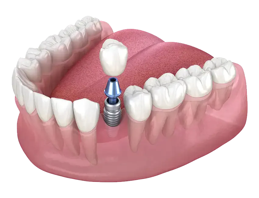 Single-Tooth Replacement