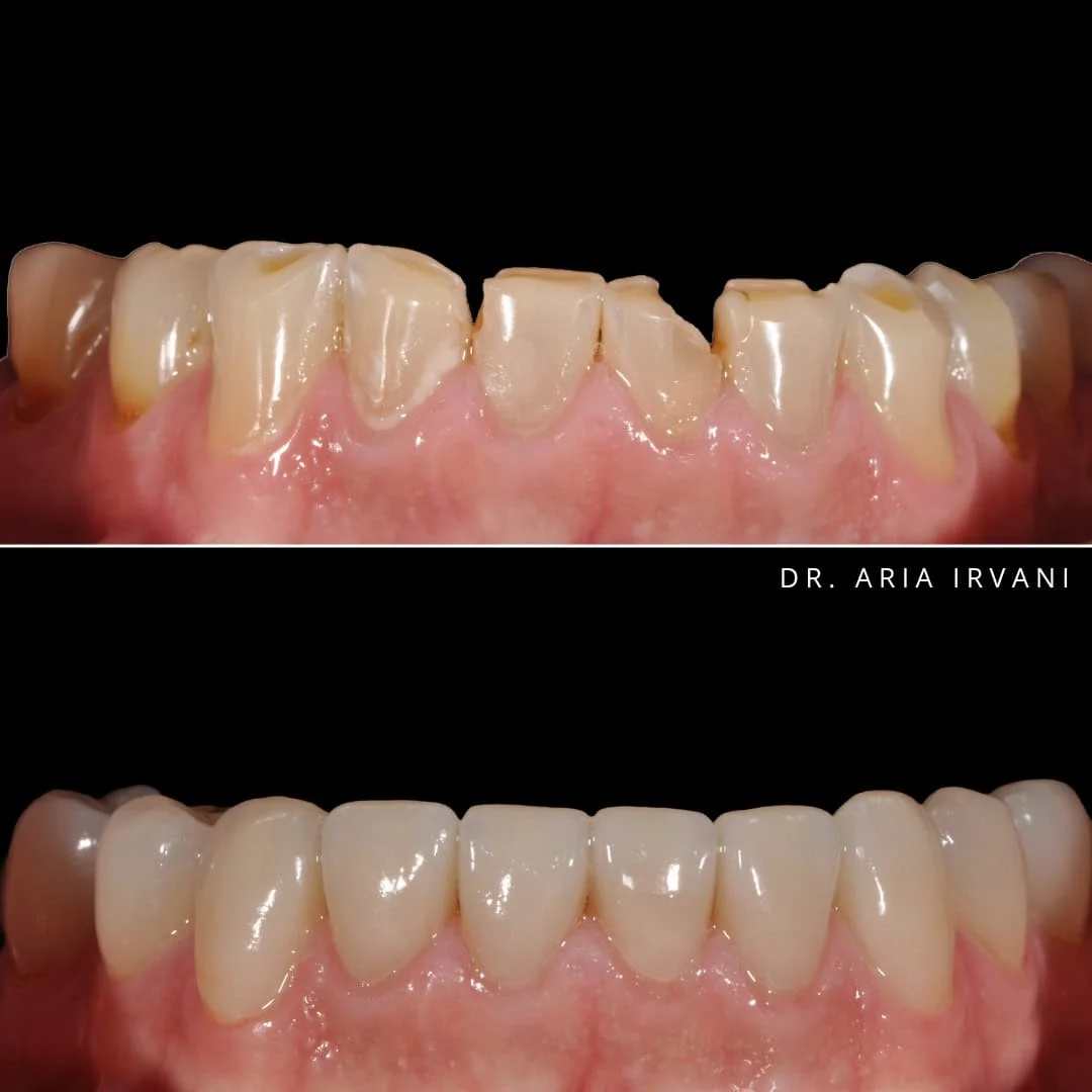 Smile makeover before and after