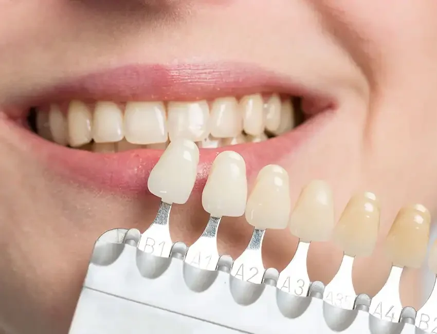 Professional Teeth Whitening in Foothill Ranch, CA
