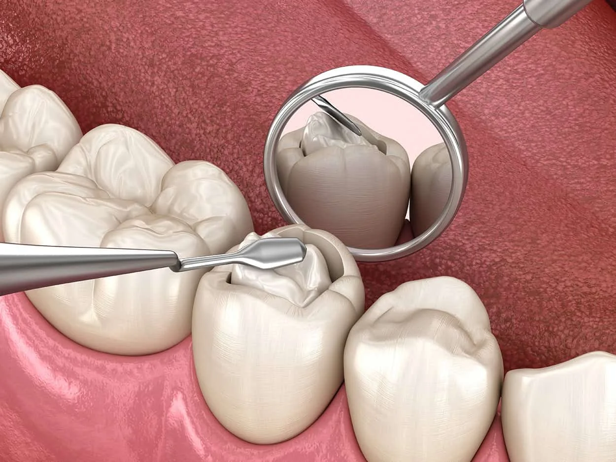 cavity being filled