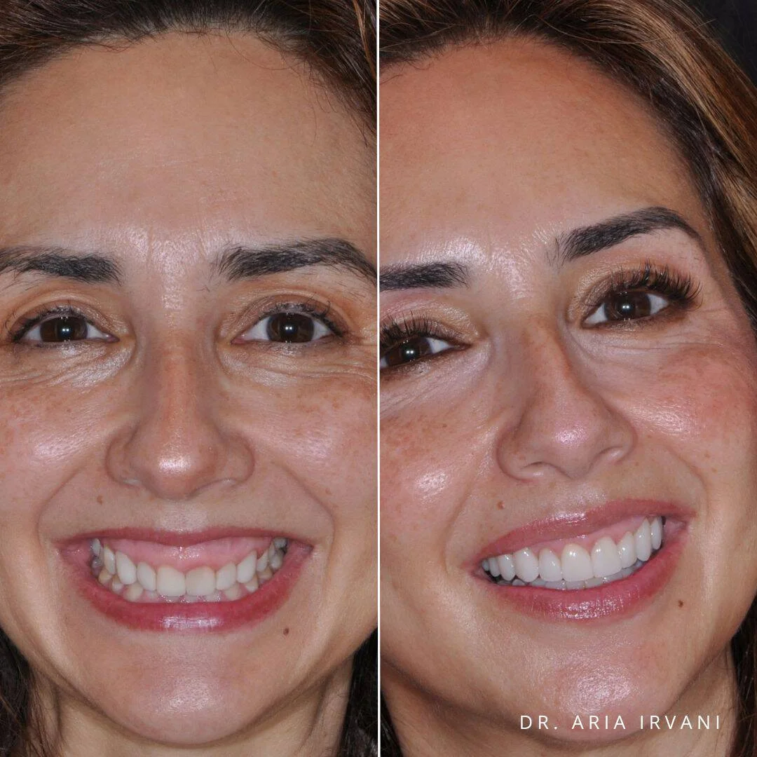 Veneers and gum recontouring before and after