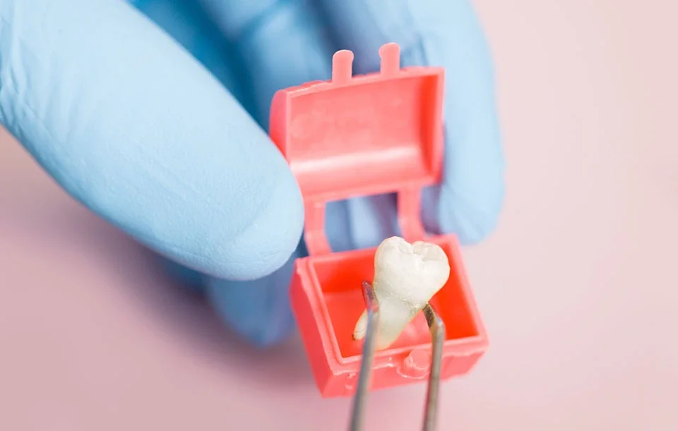 Tooth Extraction in Foothill Ranch, CA