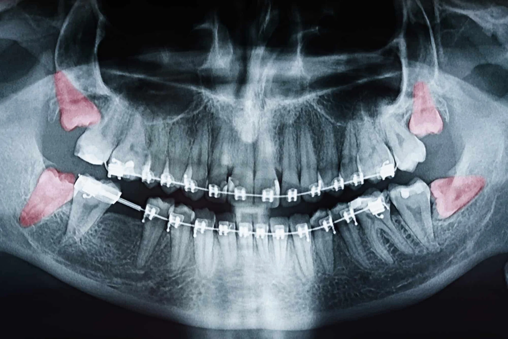 wisdom teeth removal